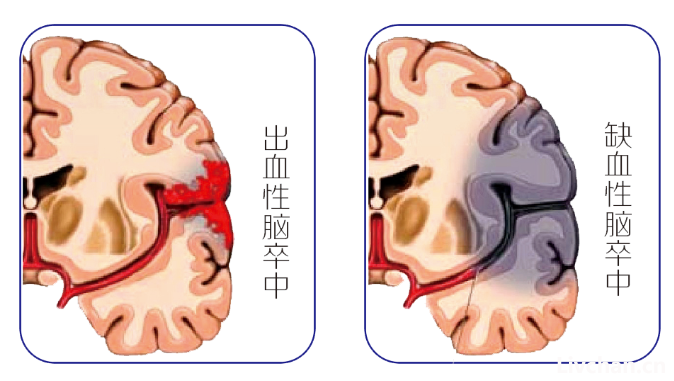 卒中预防，至关重要