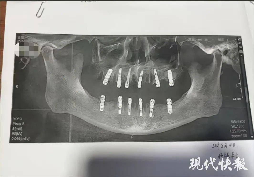 男子一次性拔牙23颗种12颗，13天后去世